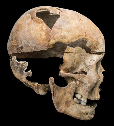 Radcliffe Infirmary: Fractured skull with trepanation and craniotomy (c) Oxford Archaeology